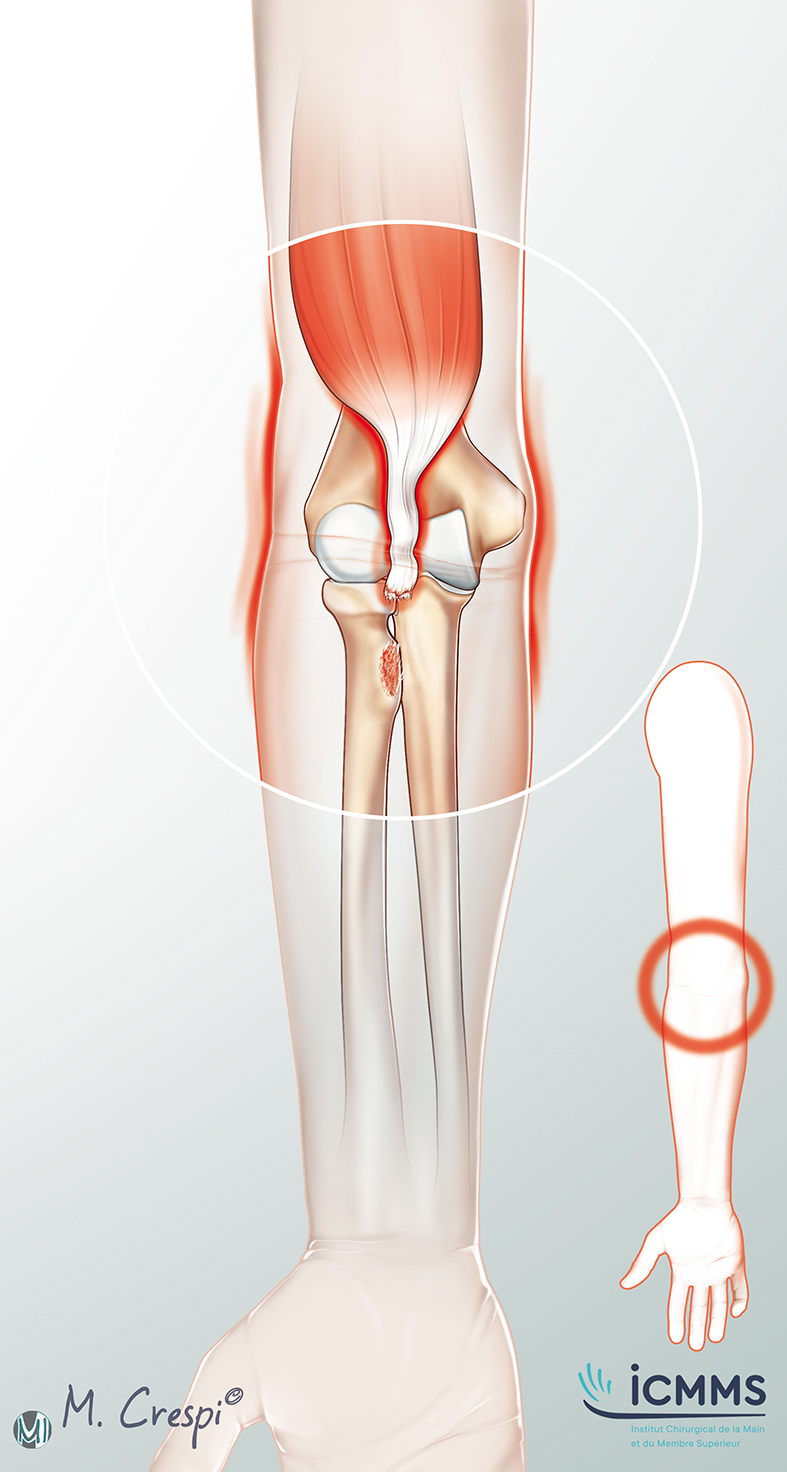 Illustration Rupture du tendon biceps au coude, pathologie du coude - ICMMS