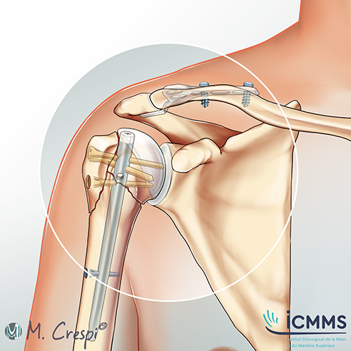 Illustration Ablation de matériel de l'épaule, pathologie de l'épaule - ICMMS