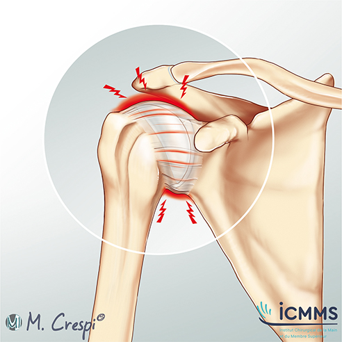 Illustration Arthrite de l'épaule, pathologie de l'épaule - ICMMS 