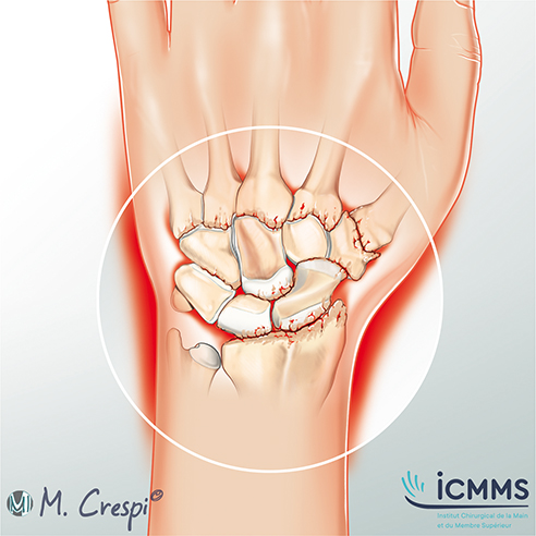 Illustration Arthrose poignet, pathologie du poignet - ICMMS