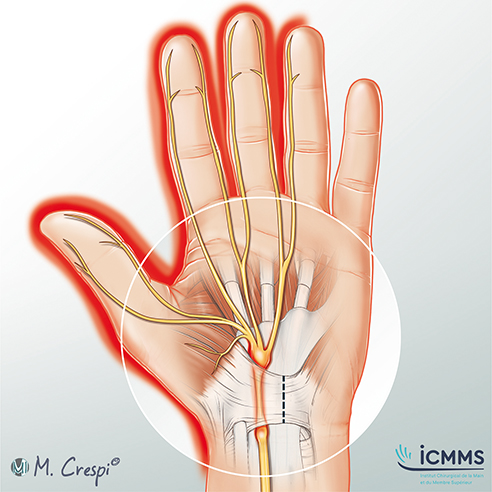 Illustration Syndrome du canal carpien, pathologie du poignet - ICMMS