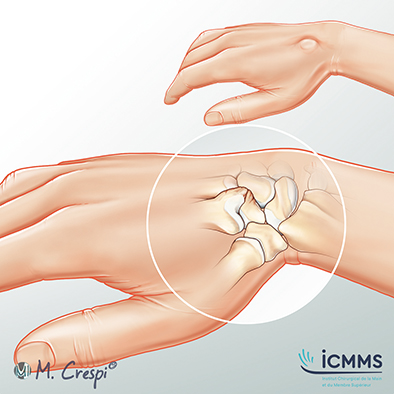 Illustration Carpe bossu, pathologie du poignet - ICMMS