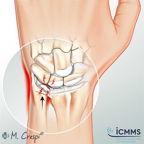 Illustration Conflit ulno-carpien, pathologie du poignet - ICMMS