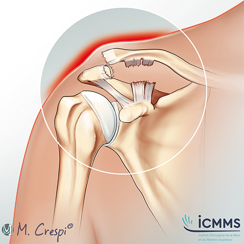 Illustration Disjonction acromio-claviculaire, pathologie du poignet - ICMMS 
