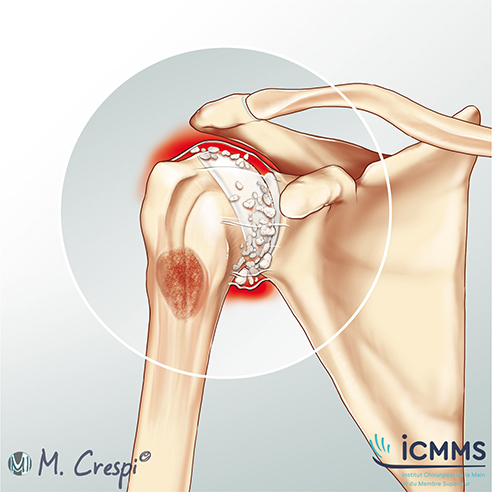 Illustration Enchondromes et corps étranger intra articulaire de l'épaule, pathologie de l'épaule - ICMMS