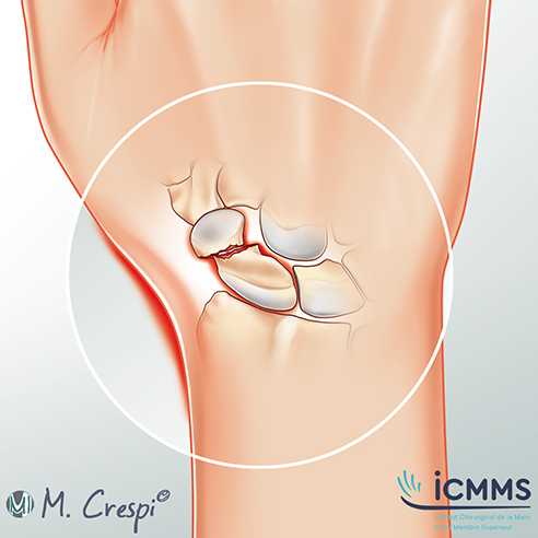 Illustration Fracture du poignet, pathologie du poignet - ICMMS