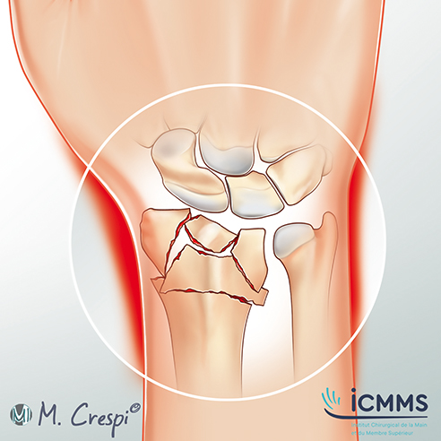 Illustration Fracture radius distal, pathologie du poignet - ICMMS