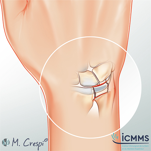 Illustration Lésion TFCC, pathologie du poignet - ICMMS