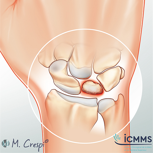 Illustration Maladie de Kienbock, pathologie du poignet - ICMMS