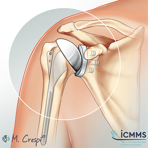 Illustration Prothèse de l'épaule, pathologie de l'épaule - ICMMS 