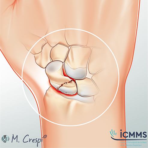 Illustration Pseudarthrose du scaphoide, pathologie du poignet - ICMMS